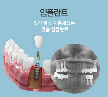 질긴 음식도 문제없는 맞춤 임플란트