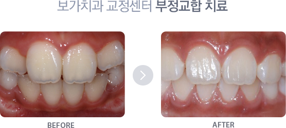 부정교합 치료사례