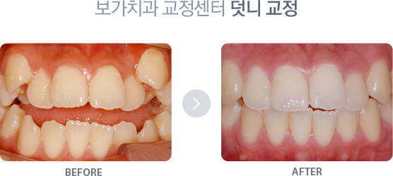 덧니 교정 치료사례 1