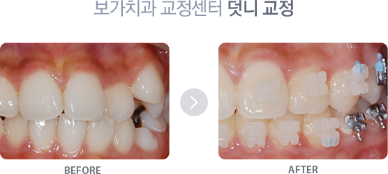 덧니 교정 치료사례 2