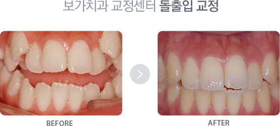 돌출입 교정 치료사례