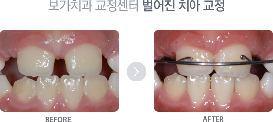 벌어진 치아교정 치료사례