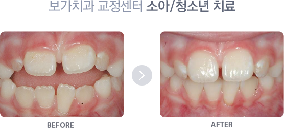 소아/청소년 교정 치료사례